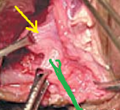 Πράσινο βέλος - εσωτερικός και κίτρινο βέλος - εξωτερικός σφιγκτήρας μετά επιμελή αποκόλληση (Ευγενική παραχώρηση Dr. V. Penopoulos)