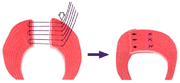 Επικαλυπτική σφιγκτηροπλαστική. Σχηματική απεικόνιση (Ευγενική παραχώρηση Dr. V. Penopoulos)