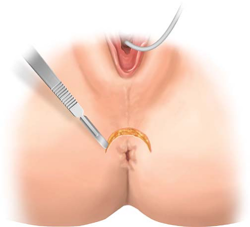 Επικαλυπτική σφιγκτηροπλαστική. Σχηματική απεικόνιση (Ευγενική παραχώρηση Dr. V. Penopoulos)