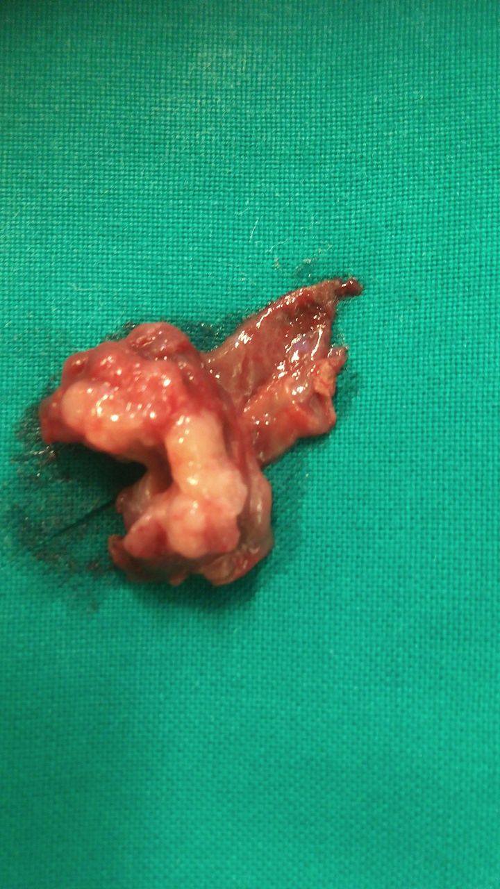 Transduodenal Ampullecktomy (Courtesy Dr. V. Penopoulos)