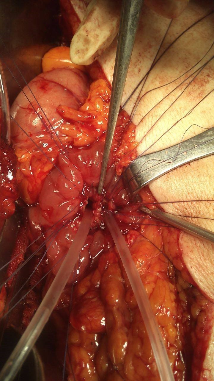 Transduodenal Ampullecktomy (Courtesy Dr. V. Penopoulos)