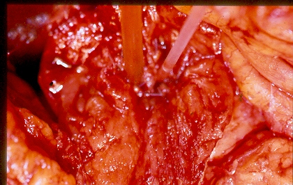 Transduodenal  Ampullecktomy (Courtesy Dr. V. Penopoulos)