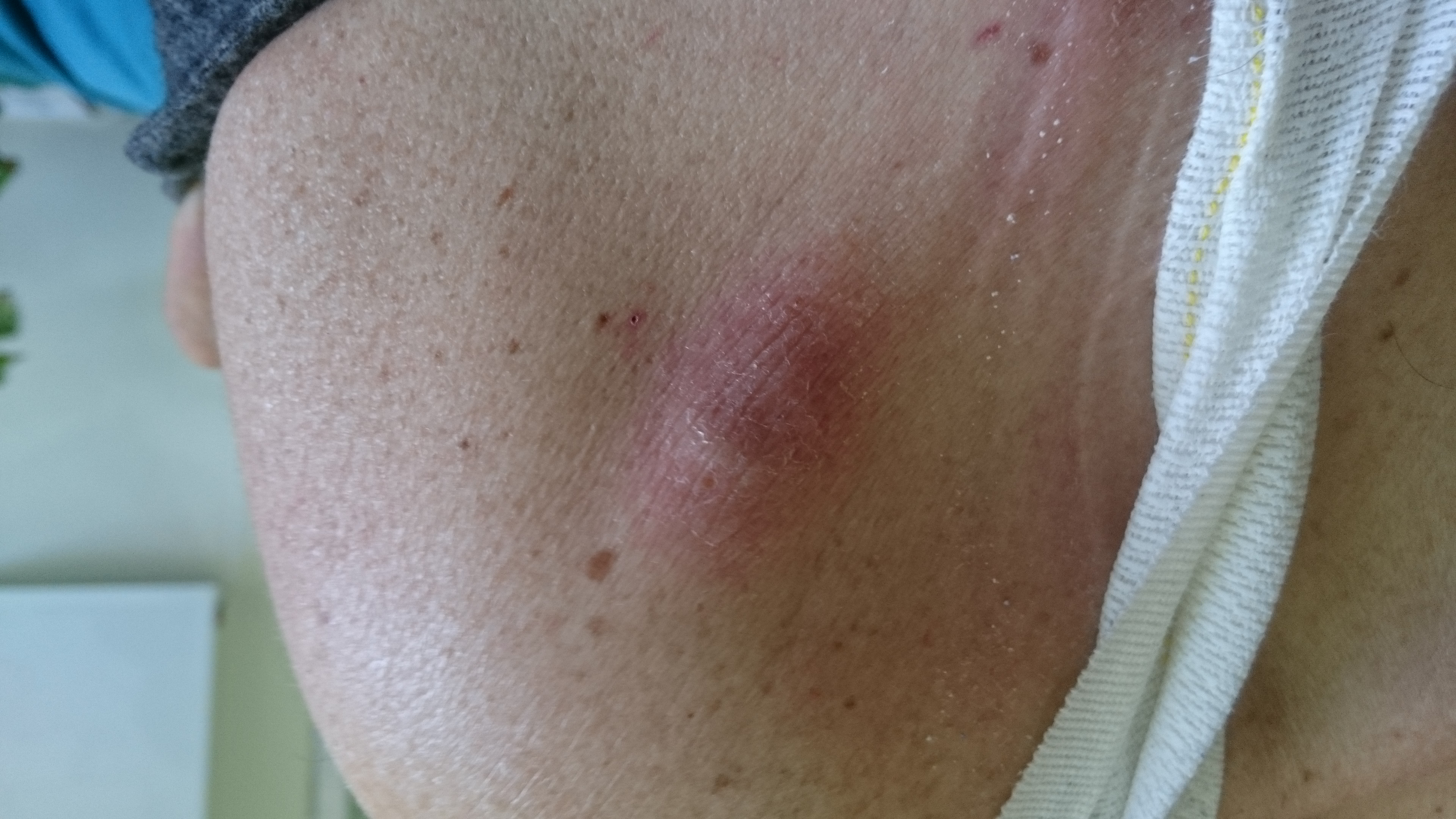 Εμφανής ο όζος λίγα εκατοστά από τον αριστερό ώμο (Ευγενική παραχώρηση Dr. V. Penopoulos)