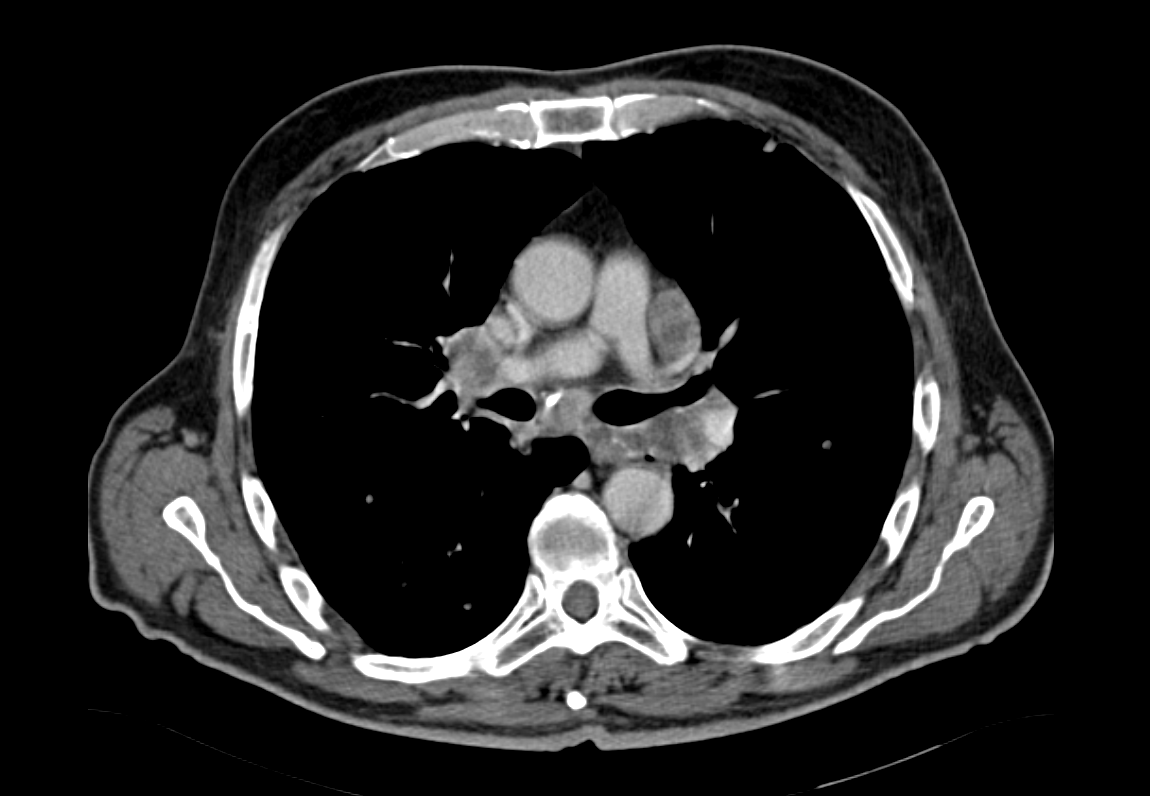 Σαφώς ορατές μεσοθωρακικές μεταστάσεις (Ευγενική παραχώρηση Dr. V. Penopoulos)