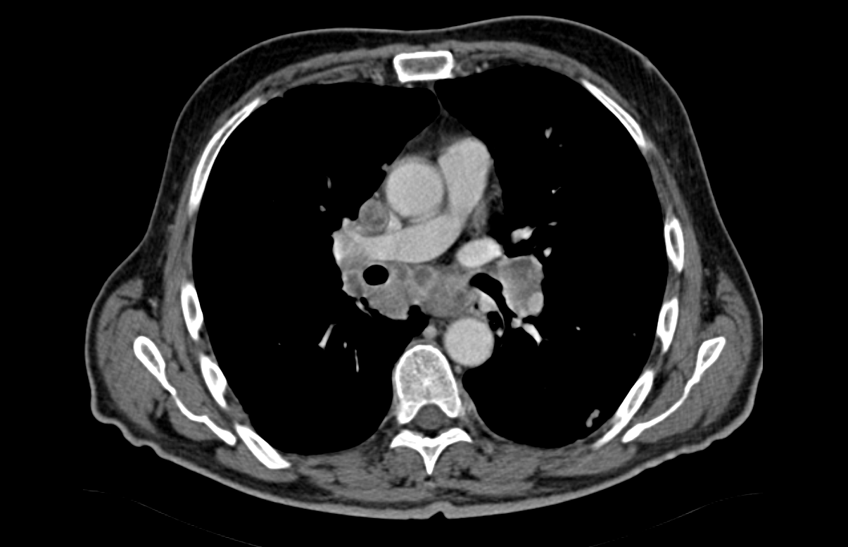 Εμφανείς μεταστατικοί λεμφαδένες πυλαίου (Ευγενική παραχώρηση Dr. V. Penopoulos)