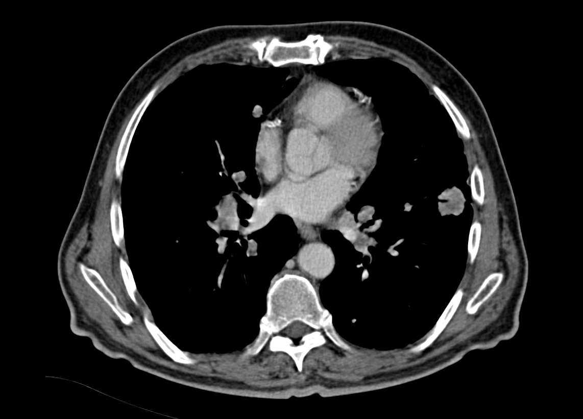 Αμφοτερόπλευροι πνευμονικοί όζοι ενδεικτικοί μεταστάσεων μελανώματος (Ευγενική παραχώρηση Dr. V. Penopoulos)