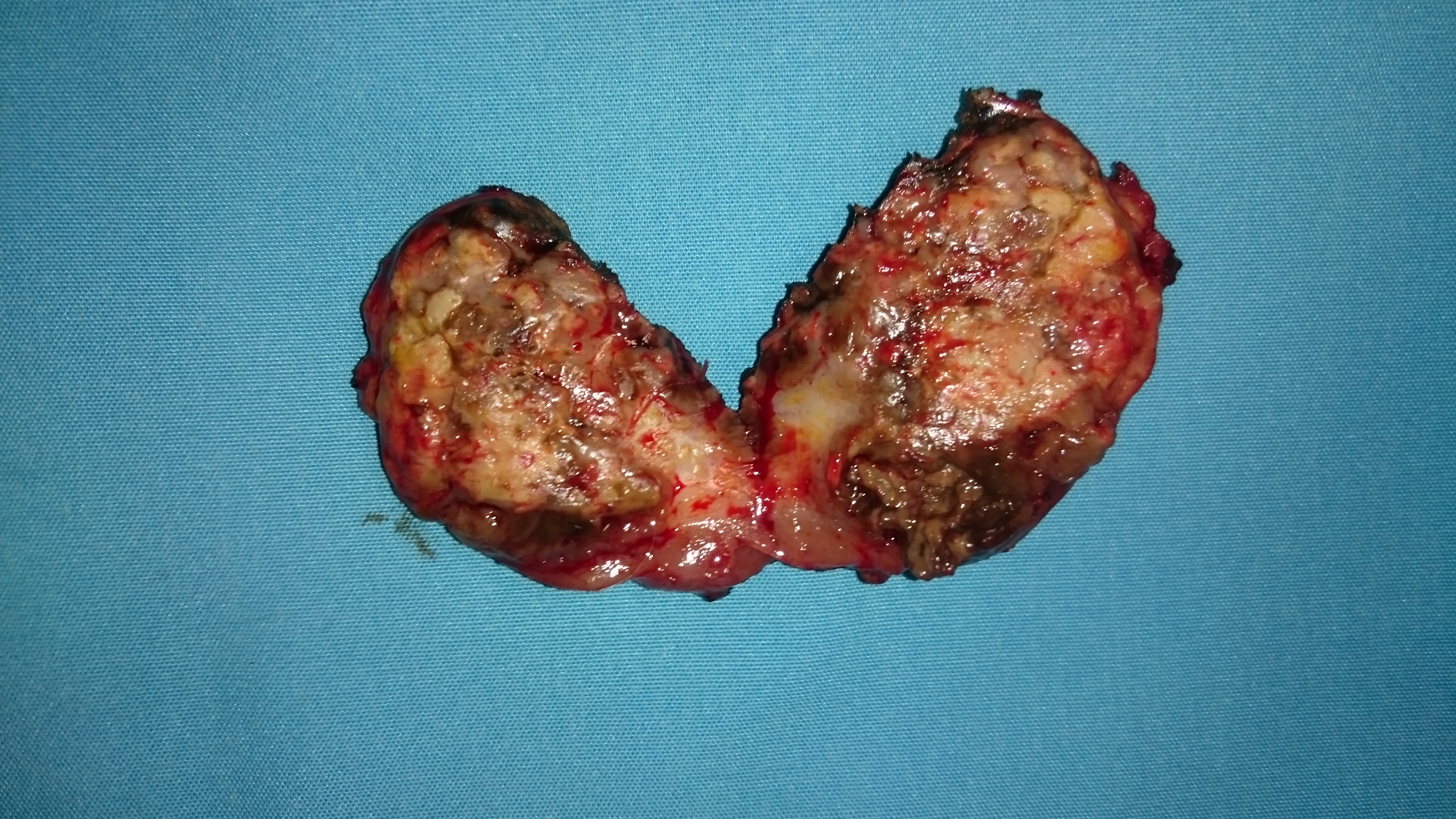 Αριστερός μασχαλιαίος λεμφαδένας, Ki67 άνω 70%, θεραπευτική παρέμβαση (Ευγενική παραχώρηση Dr. V. Penopoulos)