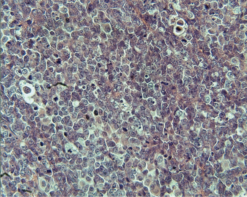 Παθολογοανατομική εξέταση δερματικής βλάβης. Χρώση αιματοξυλίνης-εοσίνης που δείχνει φωλιές μονόμορφων καρκινικών κυττάρων με μεγάλη ατυπία, βαθυχρωματικούς πυρήνες και ενεργούς μιτωτικούς δείκτες χωρίς εμφανή μελανίνη (Ευγενική παραχώρηση Dr. V. Penopoulos)