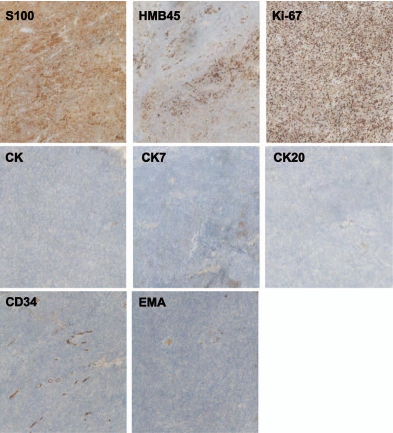 Παθολογοανατομική εξέταση δερματικής βλάβης. Χρώση αιματοξυλίνης-εοσίνης που δείχνει φωλιές μονόμορφων καρκινικών κυττάρων με μεγάλη ατυπία, βαθυχρωματικούς πυρήνες και ενεργούς μιτωτικούς δείκτες χωρίς εμφανή μελανίνη (Ευγενική παραχώρηση Dr. V. Penopoulos)