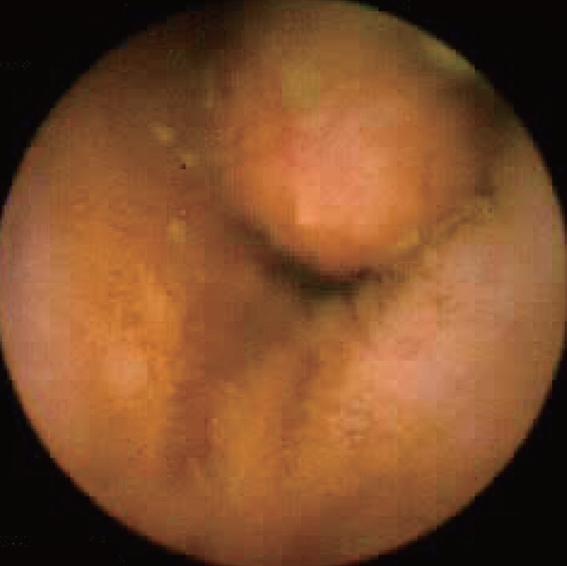 Polyps excised both surgically and endoscopically (Courtesy Dr. V. Penopoulos)