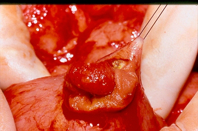 Polyps excised both surgically and endoscopically (Courtesy Dr. V. Penopoulos)