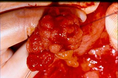 Polyps excised both surgically and endoscopically (Courtesy Dr. V. Penopoulos)