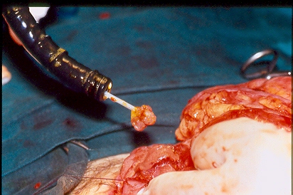 Polyps  excised  both  surgically  and  endoscopically (Courtesy Dr. V. Penopoulos)