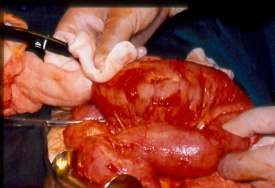 Polyps  excised  both  surgically  and  endoscopically (Courtesy Dr. V. Penopoulos)
