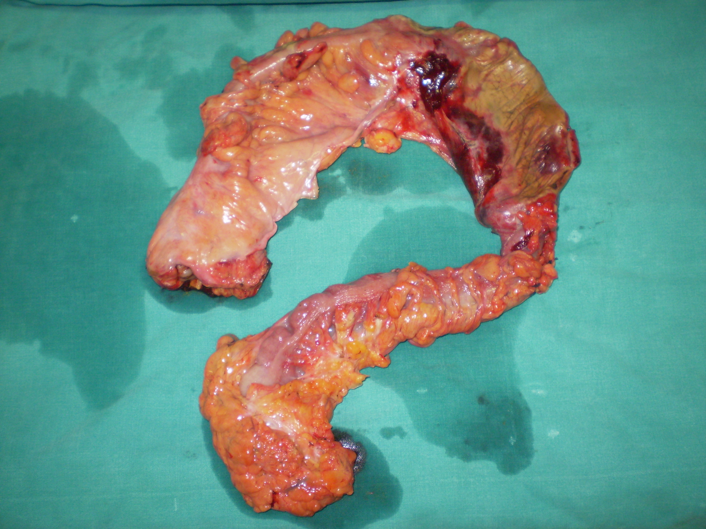 Εκτεταμένη κολεκτομή ισχαιμικού νεκρωτικού παχέος εντέρου (Ευγενική παραχώρηση Dr. V. Penopoulos)