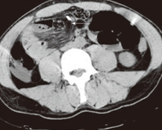 Αξονική τομογραφία. Ύποπτη στροφή μεσεντερίου άνω κοιλίας, εντερικός βρόχος στο κάτω δεξί τεταρτημόριο, διαχωρισμός στη μέση γραμμή κοιλίας (Ευγενική παραχώρηση Dr. V. Penopoulos)