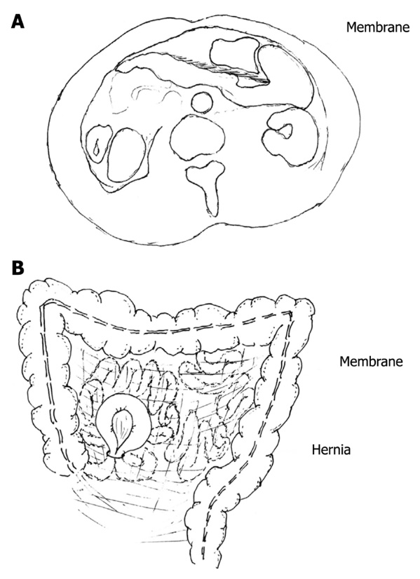 Υπερηχογράφημα κοιλίας και νεφρών χωρίς ανεύρεση μάζας ή συλλογής υγρού (Α), φυσιολογική δομή αριστερού (Β) και δεξιού (Γ) νεφρού (Ευγενική παραχώρηση Dr. V. Penopoulos)