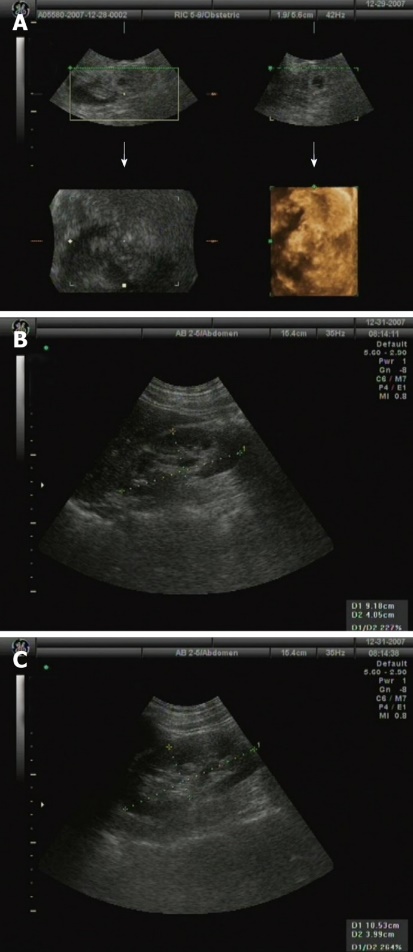 Υπερηχογράφημα κοιλίας και νεφρών χωρίς ανεύρεση μάζας ή συλλογής υγρού (Α), φυσιολογική δομή αριστερού (Β) και δεξιού (Γ) νεφρού (Ευγενική παραχώρηση Dr. V. Penopoulos)