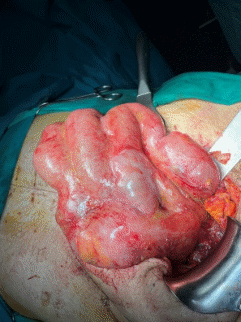 CT άνω κοιλίας με σκιαγραφικό που αναδεικνύει συστάδα διατεταμένων ελίκων λεπτού εντέρου στο κέντρο δίνοντας εικόνα κουνουπιδιού (βέλη) (Ευγενική παραχώρηση Dr. V. Penopoulos)