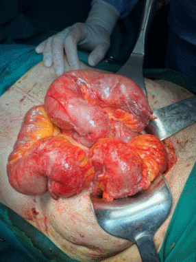 CT άνω κοιλίας με σκιαγραφικό που αναδεικνύει συστάδα διατεταμένων ελίκων λεπτού εντέρου στο κέντρο δίνοντας εικόνα κουνουπιδιού (βέλη) (Ευγενική παραχώρηση Dr. V. Penopoulos)