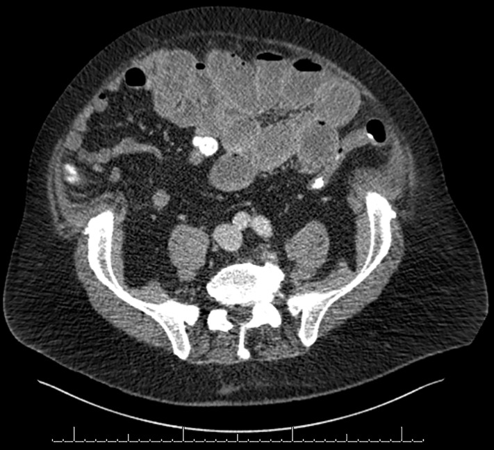 CT κοιλίας με σκιαγραφικό που αναδεικνύει το λεπτό έντερο στο κέντρο της κοιλίας εντός παχέος ινώδους υμένα (Ευγενική παραχώρηση Dr. V. Penopoulos)