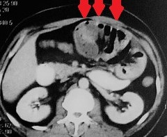 Λεπτό έντερο ελεύθερο μετά από μεθοδική αδρανοποίηση συμφύσεων (Ευγενική παραχώρηση Dr. V. Penopoulos)