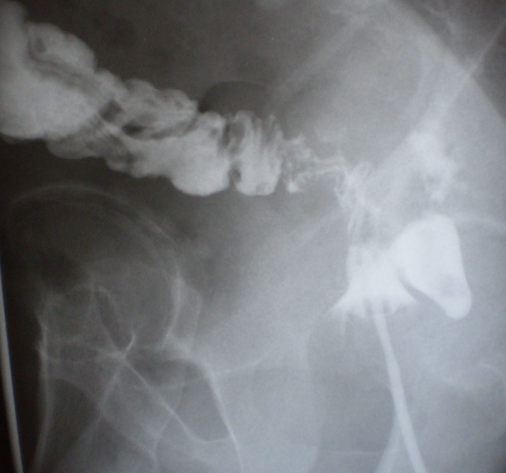 Εμφανής η ιατρογενής διάτρηση (κόκκινο βέλος) (Ευγενική παραχώρηση Dr. V. Penopoulos)