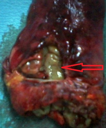 Εμφανής η ιατρογενής διάτρηση (κόκκινο βέλος) (Ευγενική παραχώρηση Dr. V. Penopoulos)
