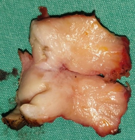 Εκτομένος ομφαλός μαζί με SMJN (Ευγενική παραχώρηση Dr. V. Penopoulos)