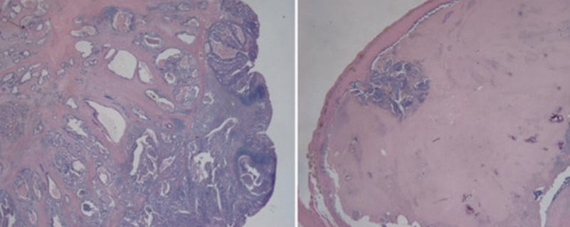 Εκτομένος ομφαλός μαζί με SMJN (Ευγενική παραχώρηση Dr. V. Penopoulos)