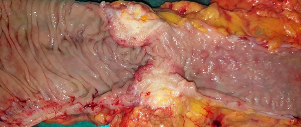 Εκτομένος ομφαλός μαζί με SMJN (Ευγενική παραχώρηση Dr. V. Penopoulos)