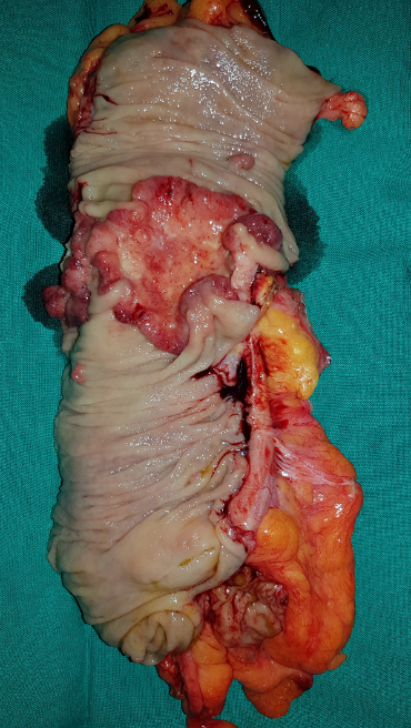 Μακροσκοπική εμφάνιση ωοθήκης μετά ολική υστερεκτομή σε γυναίκα 46 ετών με μετάχρονες ωοθηκικές μεταστάσεις που διαγνώστηκαν δύο χρόνια μετά δεξιά ημικολεκτομή για καρκίνωμα ανιόντος κόλου. Η μακροσκοπική εμφάνιση του ωοθηκικού όγκου αναδεικνύει κυστικές και στερεές περιοχές (Ευγενική παραχώρηση Dr. V. Penopoulos)