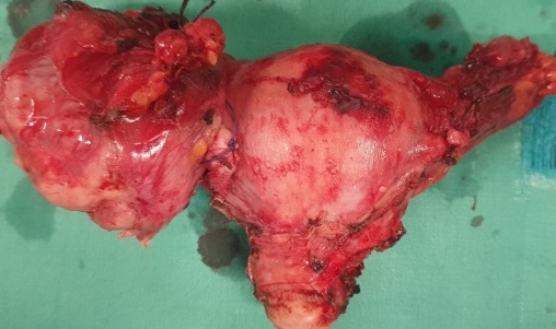 Μικροφωτογραφίες ιστοπαθολογίας ωοθηκικού ιστού που αναδεικνύουν στερεές περιοχές αποτελούμενες κυρίως από θηλώδεις δομές και λίγους αδένες καλυπτόμενους από στρώμα κακοήθων επιθηλιακών κυττάρων (Ευγενική παραχώρηση Dr. V. Penopoulos)