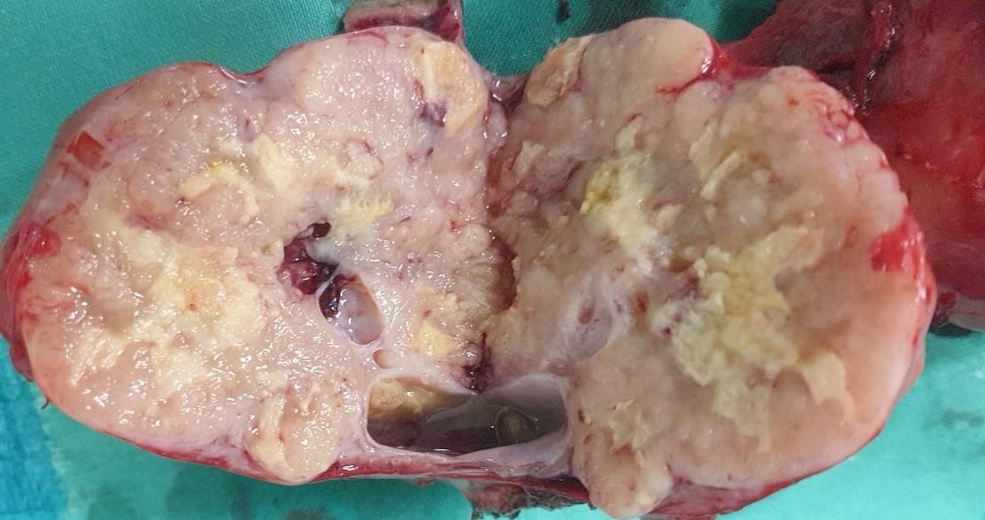 Θετική ανοσοϊστοχημεία για CDX2 και κυτοκερατίνη 20 του ωοθηκικού όγκου (Ευγενική παραχώρηση Dr. V. Penopoulos)