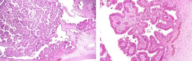 Θετική ανοσοϊστοχημεία για CDX2 και κυτοκερατίνη 20 του ωοθηκικού όγκου (Ευγενική παραχώρηση Dr. V. Penopoulos)