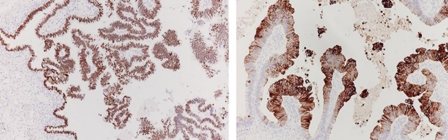 Θετική ανοσοϊστοχημεία για CDX2 και κυτοκερατίνη 20 του ωοθηκικού όγκου (Ευγενική παραχώρηση Dr. V. Penopoulos)