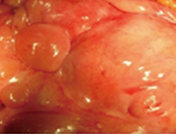 Mesenteric ( various sizes ) liposarcomas (Courtesy Dr. V. Penopoulos)