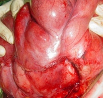 Mesocolic liposarcoma (Courtesy Dr. V. Penopoulos)