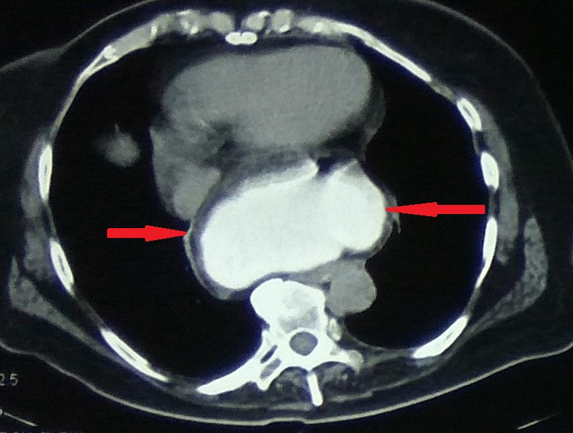 Different views of a double contrast-enhanced CT scan showing a left diaphragmatic hernia with an acute dilated stomach (Courtesy Dr. V. Penopoulos)