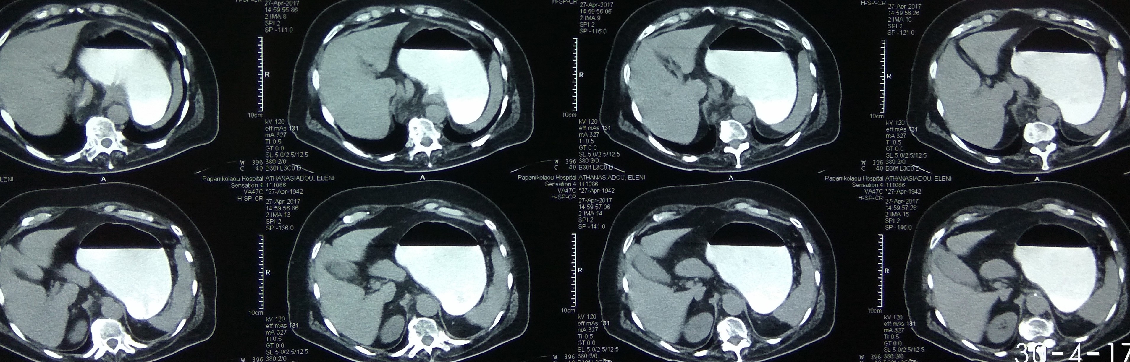 Diaphragmatic hernia before and after reduction of the stomach (Courtesy Dr. V. Penopoulos)