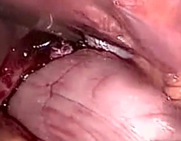 Water-soluble gastrografin meal showing postoperative normal positioning of stomach (Courtesy Dr. V. Penopoulos)
