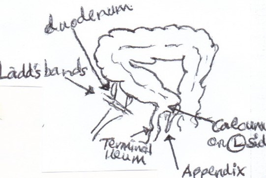 Διερευνητική λαπαροτομία. Κακοστροφή μέσου εντέρου εμφανώς ορατή. Λεπτό έντερο στη δεξιά κοιλία ενώ παχύ έντερο στην αριστερή. Σημειώνεται σκωληκοειδής απόφυση στο αριστερό λαγόνιο βόθρο (Ευγενική παραχώρηση Dr. V. Penopoulos)