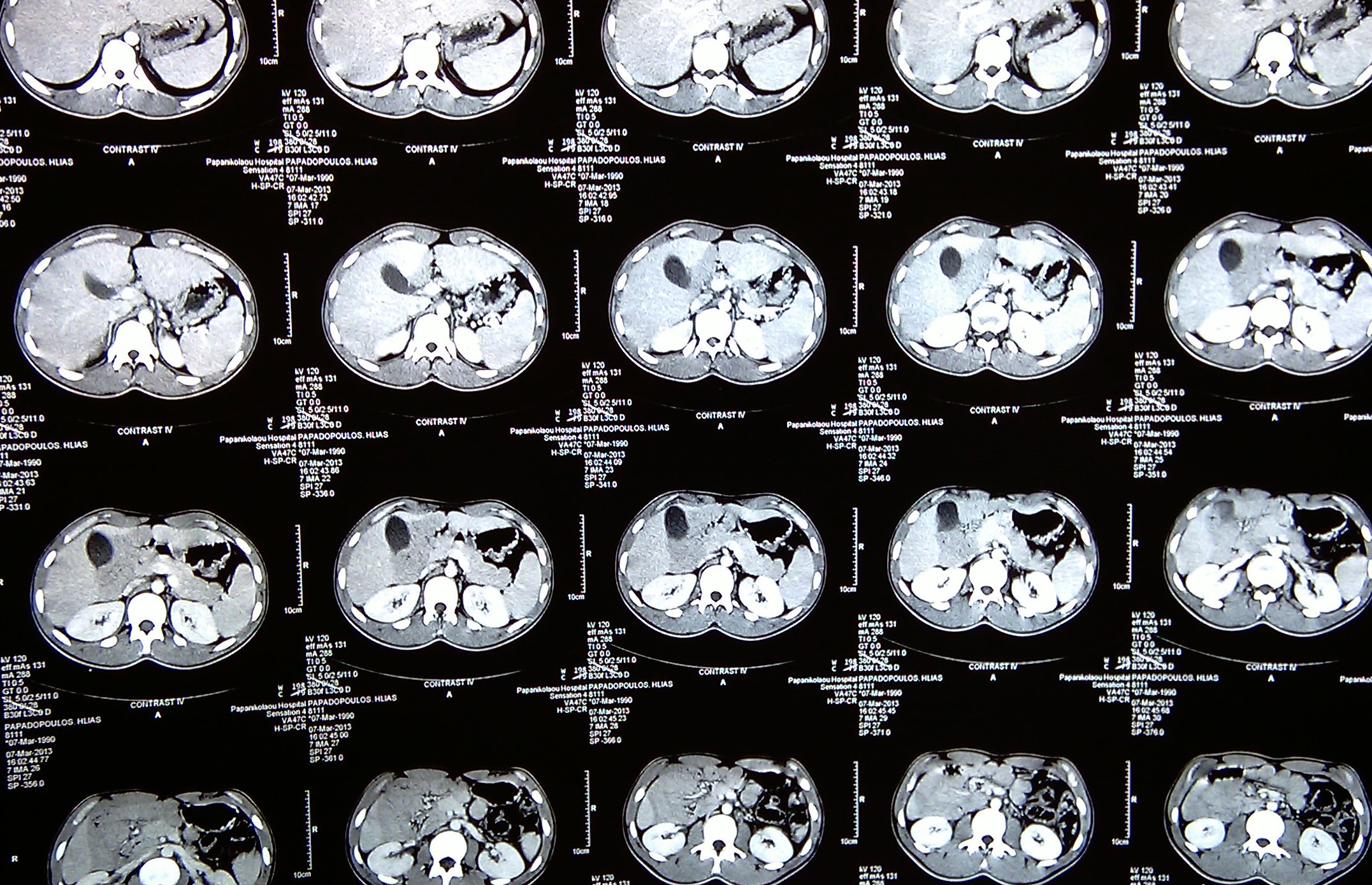 Η τομή ταινιών Ladd υποδεικνύεται από ανατομική λαβίδα (Ευγενική παραχώρηση Dr. V. Penopoulos)