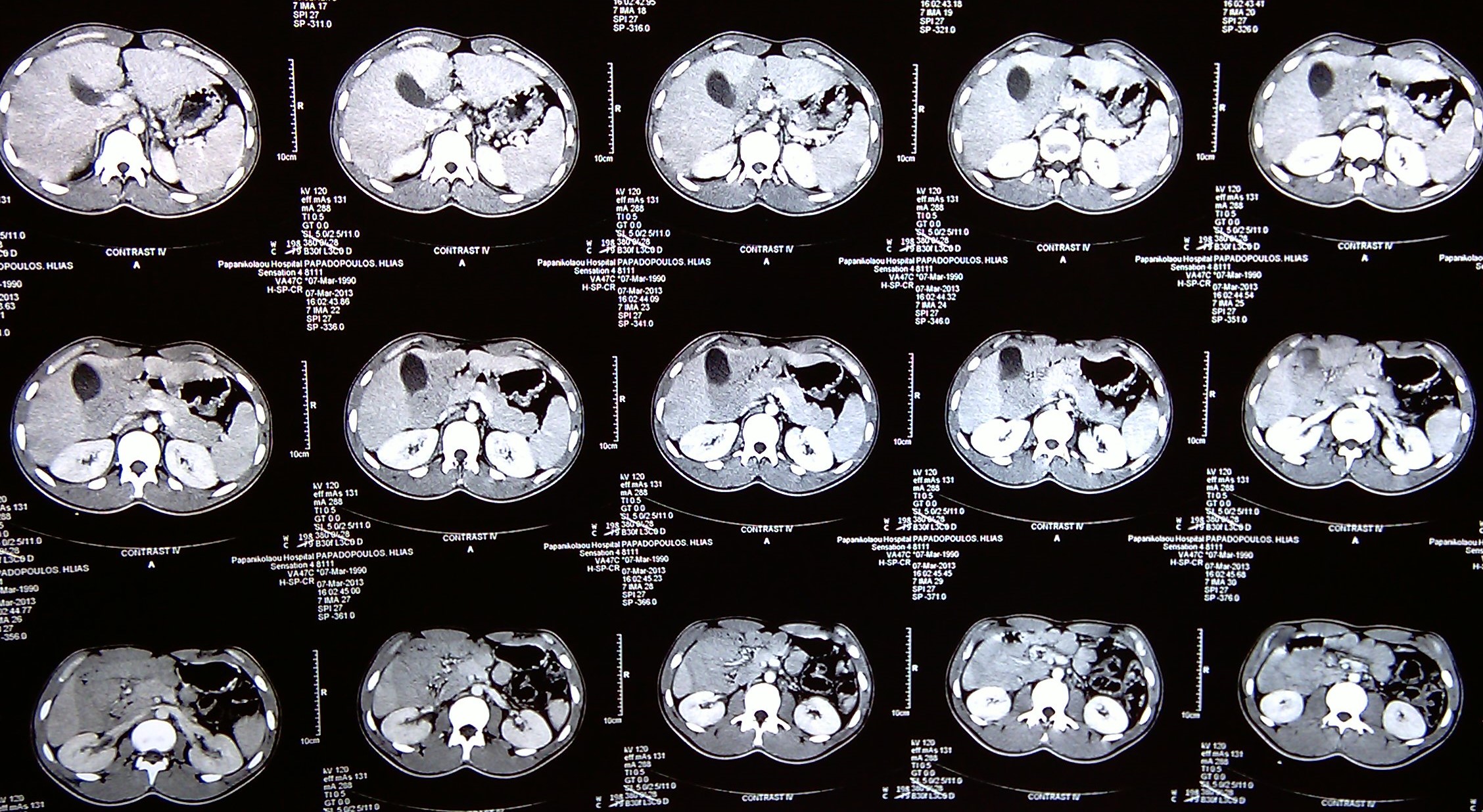Η τομή ταινιών Ladd υποδεικνύεται από ανατομική λαβίδα (Ευγενική παραχώρηση Dr. V. Penopoulos)