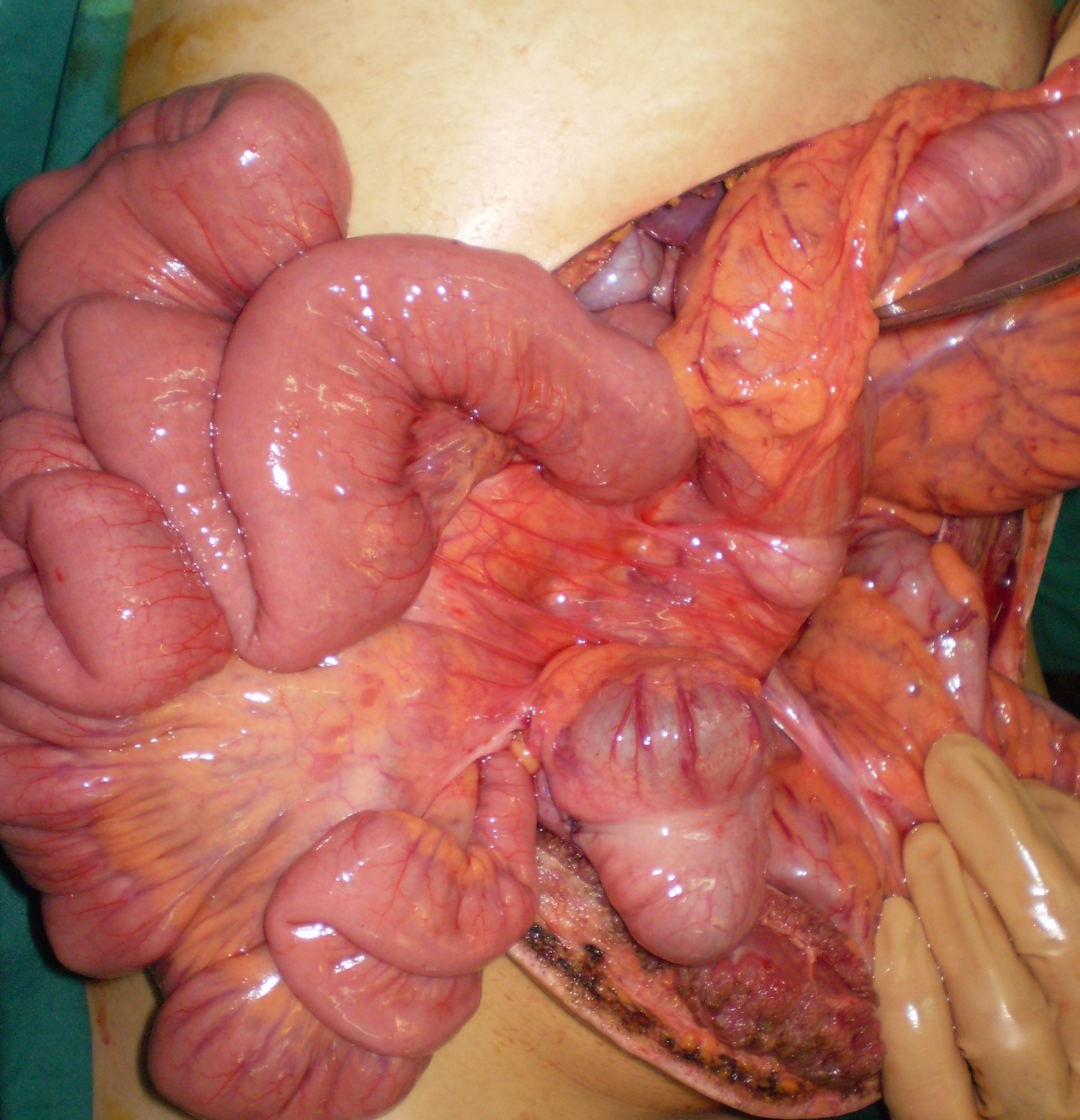 Η τομή ταινιών Ladd υποδεικνύεται από ανατομική λαβίδα (Ευγενική παραχώρηση Dr. V. Penopoulos)