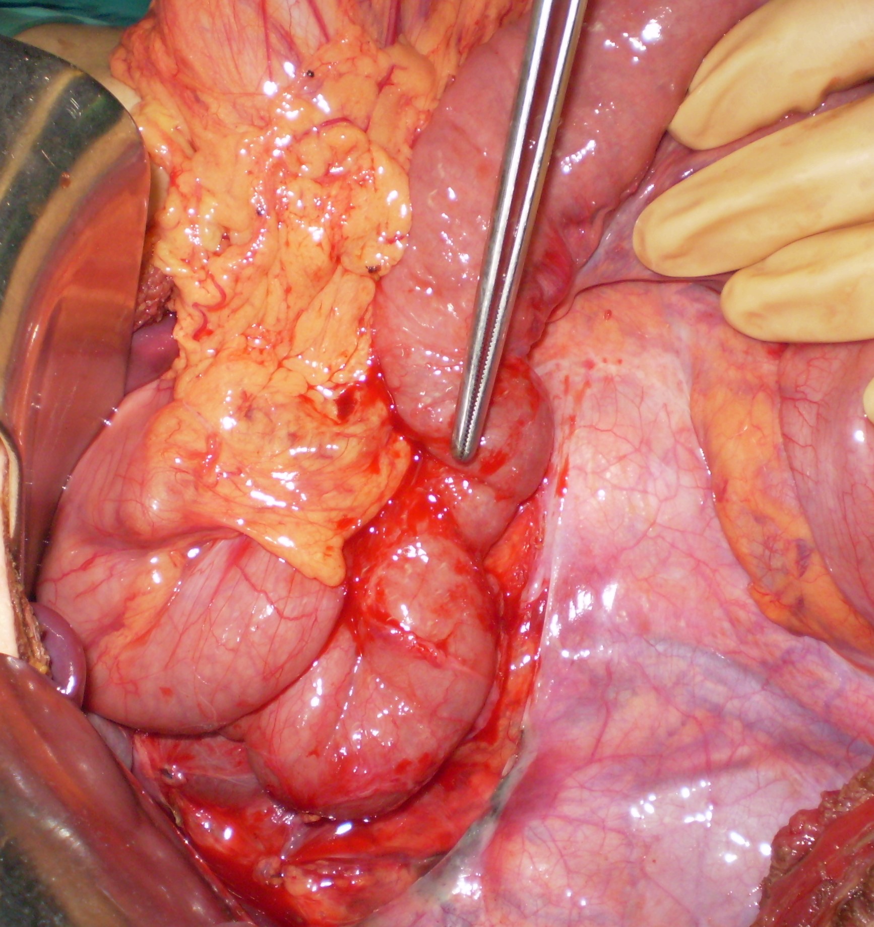 Η τομή ταινιών Ladd υποδεικνύεται από ανατομική λαβίδα (Ευγενική παραχώρηση Dr. V. Penopoulos)