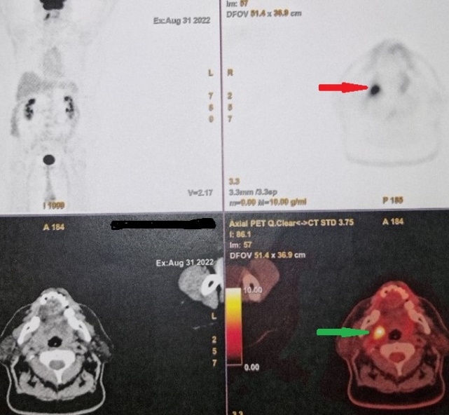 PET Scan. Μεταστατικό καρκίνωμα στη δεξιά υπερώια αμυγδαλή (Ευγενική παραχώρηση Dr. V. Penopoulos).