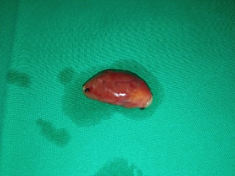 Solid  parathyroid  adenoma (Courtesy Dr. V. Penopoulos)