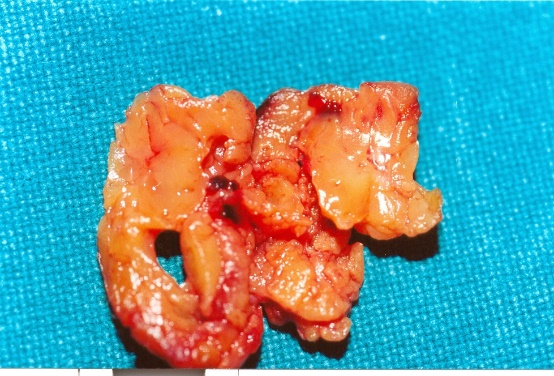 Solid parathyroid adenoma (Courtesy Dr. V. Penopoulos)