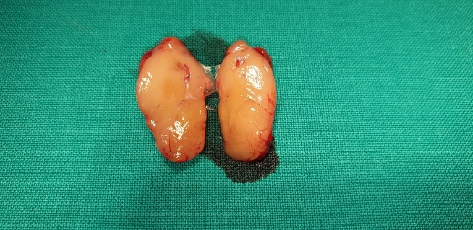 Solid  parathyroid  adenoma (Courtesy Dr. V. Penopoulos)